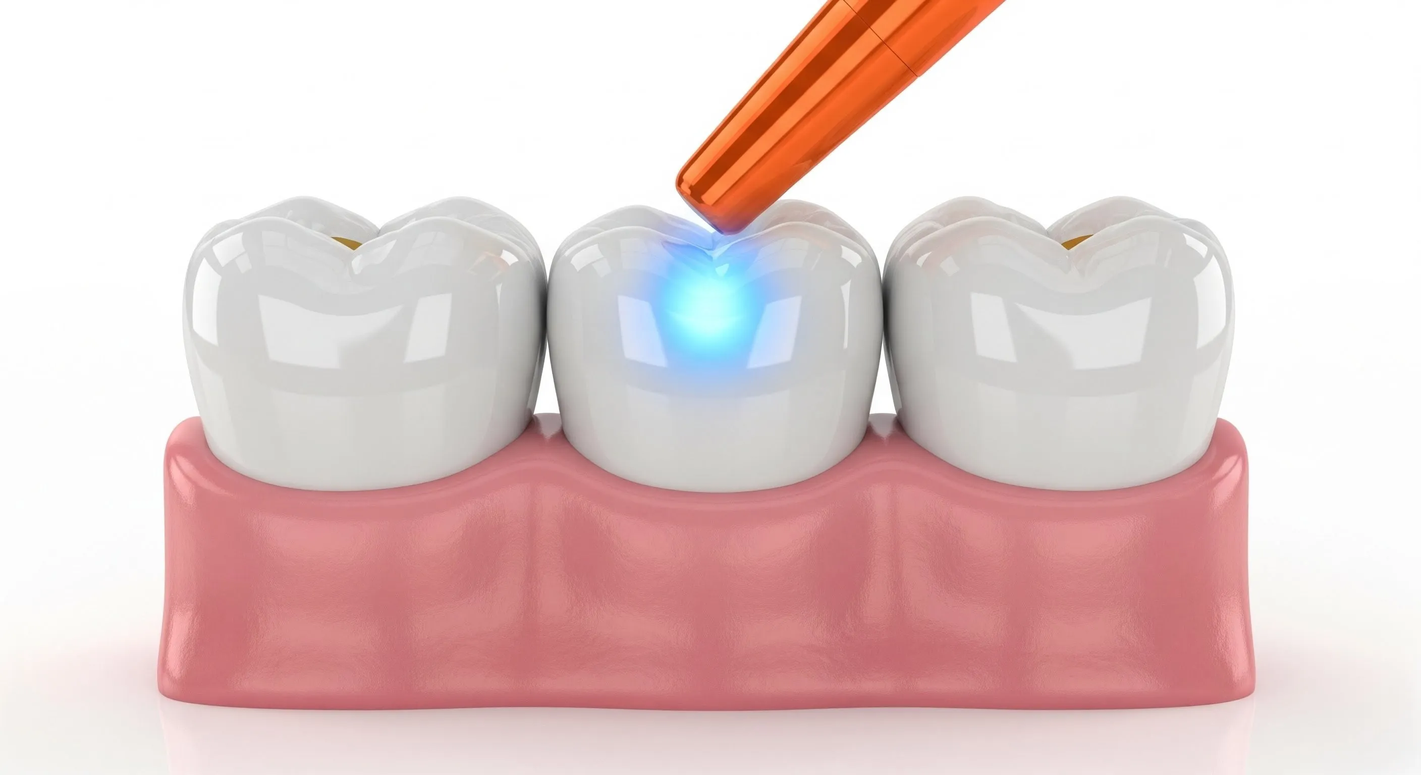 Composite Fillings Cost and Pricing Information in New Britain