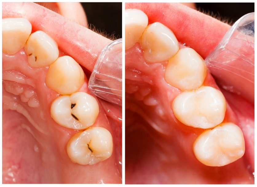 Composite fillings