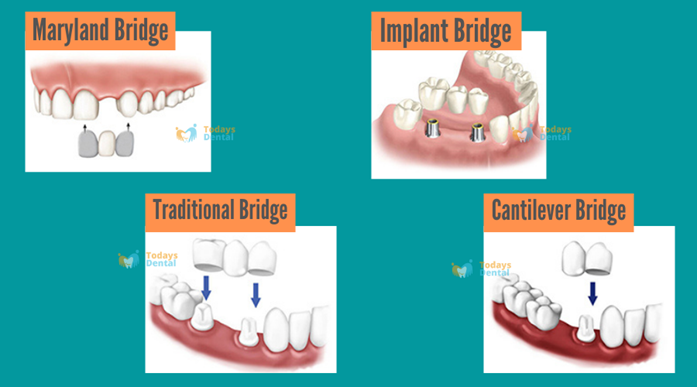   Dentist in New Britain - Dental Bridges