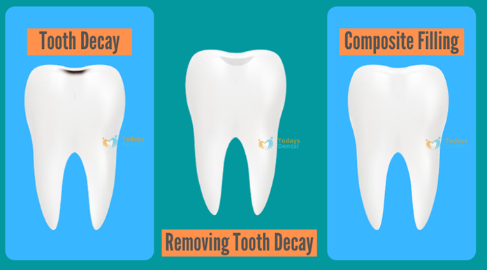 Dentist in New Britain - Composite Filling