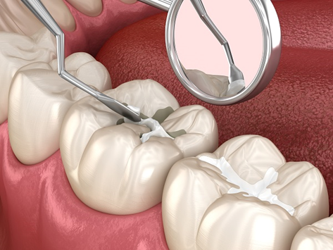   Dentist in New Britain - Dental Sealants